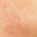 Skin Allergy